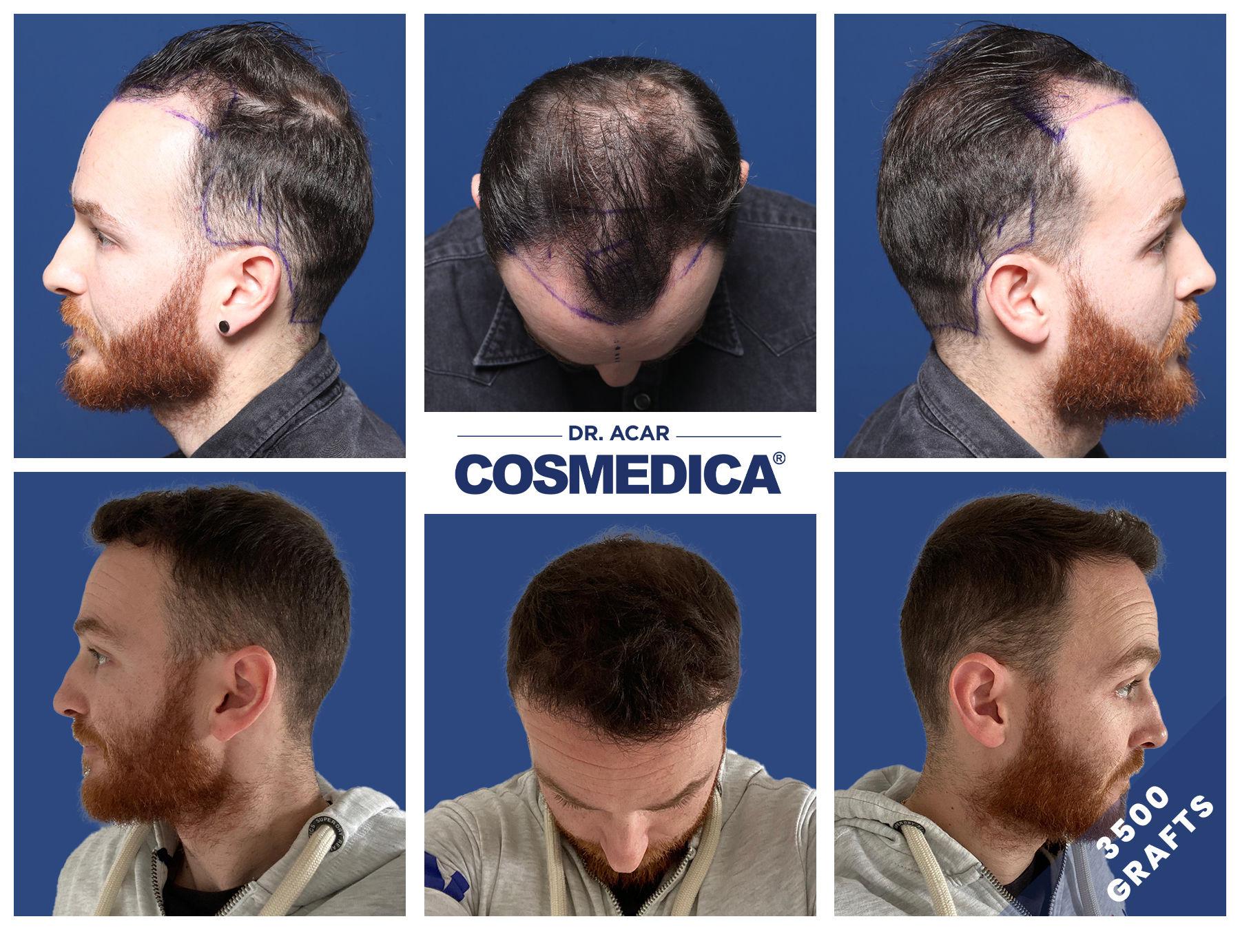 turkey hair clinics image  apr