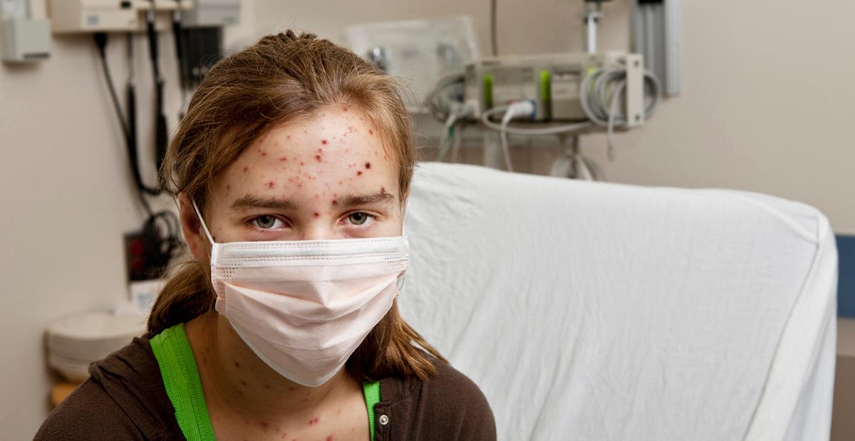 Are Chicken Pox Parties Safe?
