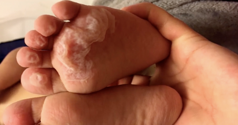 Shoeless Toddler to Get 2nd-Degree Burns