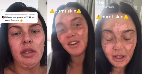 Burned face from TikTok hack