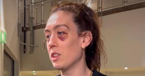Breanna Stewart shows off her nasty black eye.