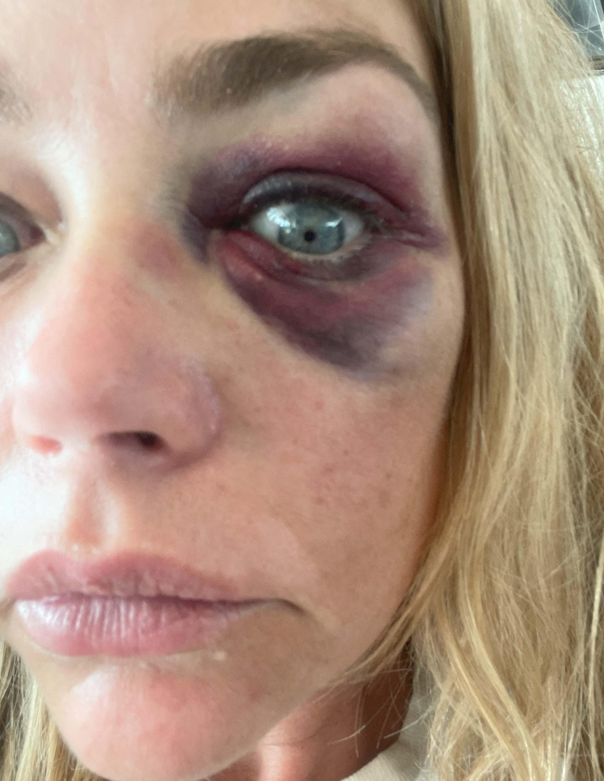 Denise Richards's image of her with a black eye from her restraining order filing against Aaron Phypers.