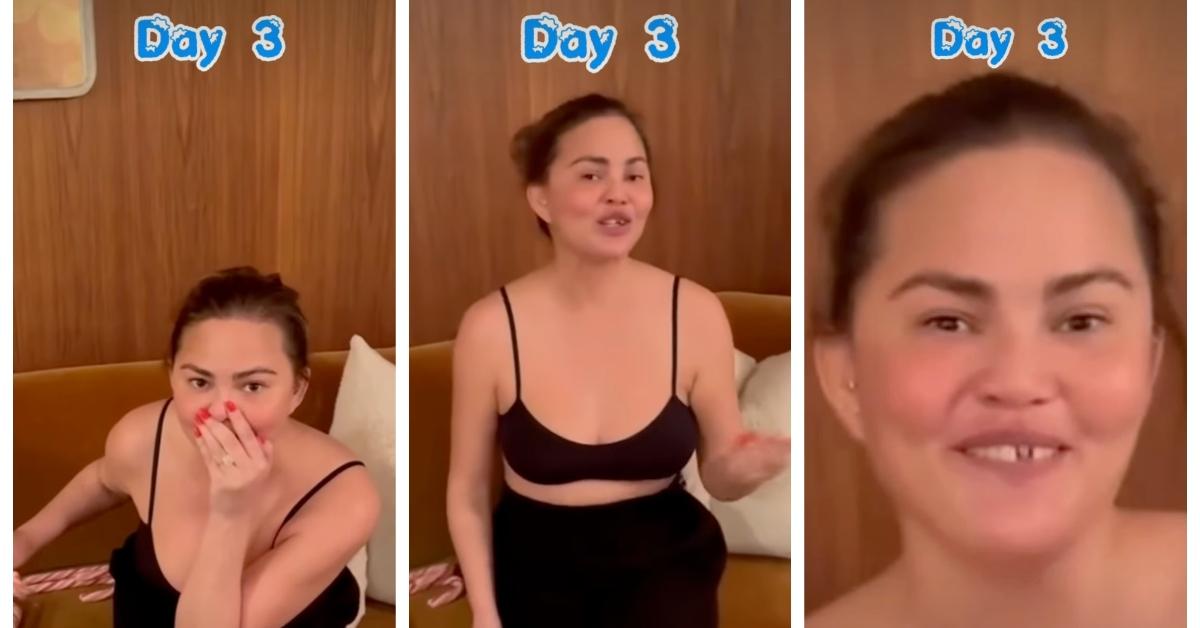 Chrissy Teigen and her missing tooth