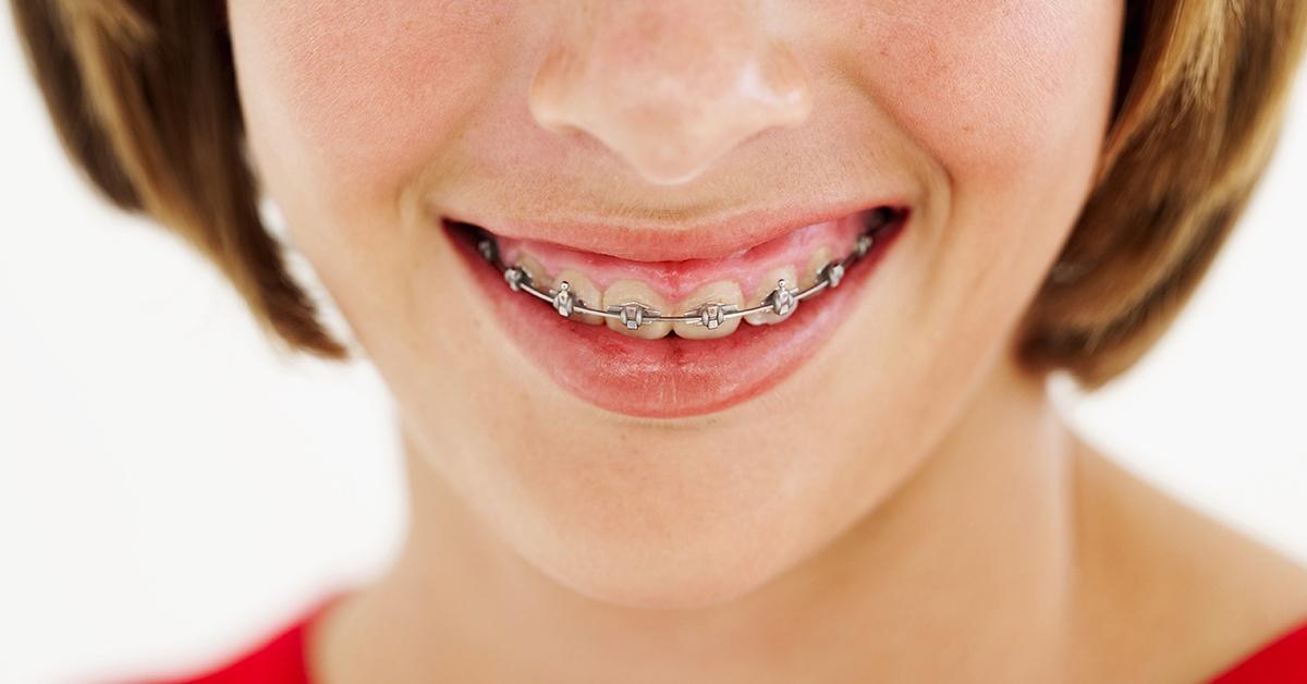A girl smiling with braces