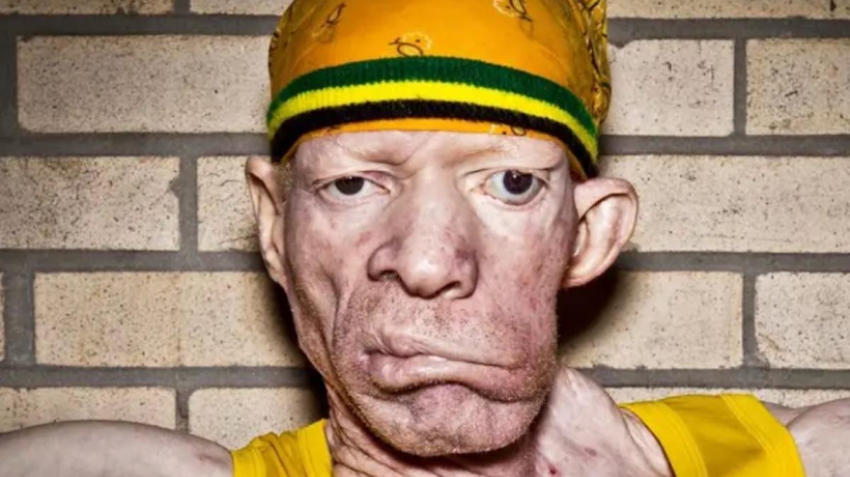 What Happened to Dancehall Star Yellowman’s Face?
