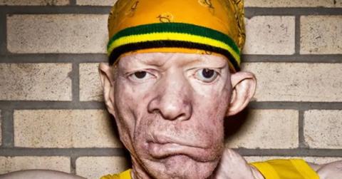 What Happened to Dancehall Star Yellowman’s Face?