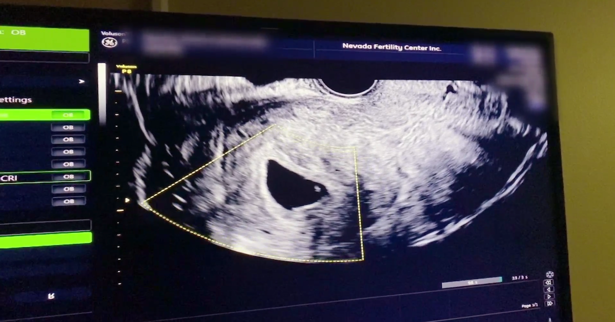 Karen Derrico sonogram