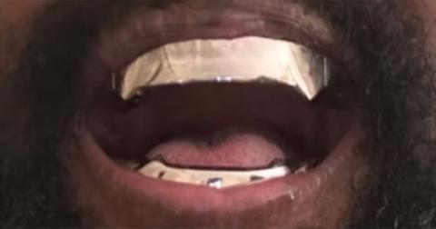 Kanye West shows off his new teeth.