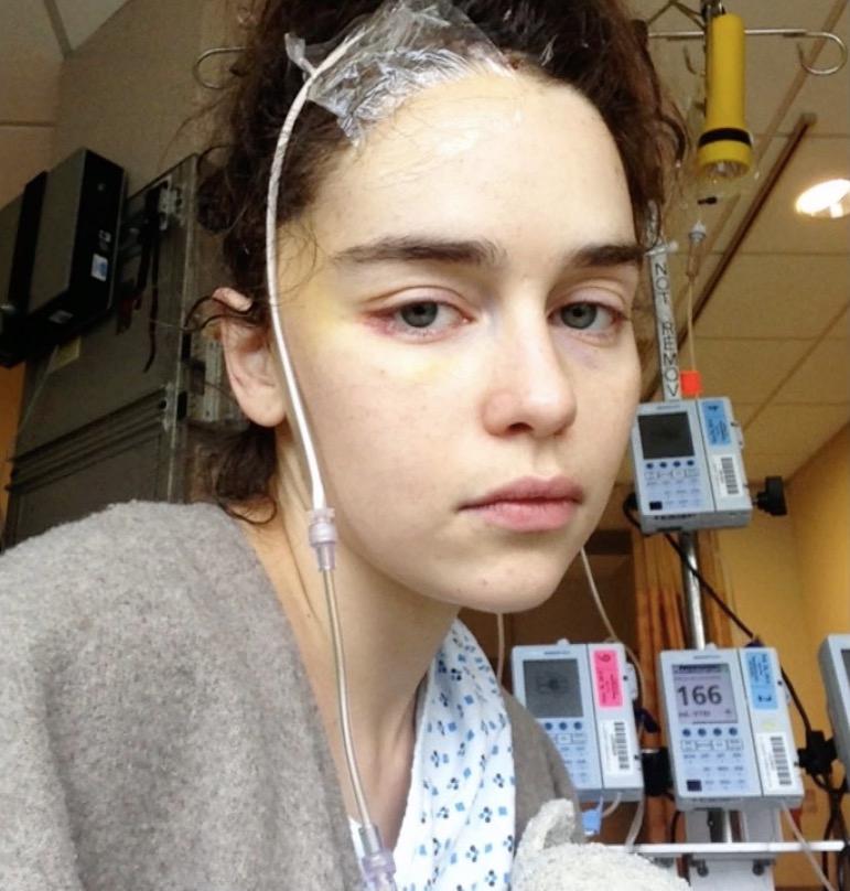 emilia clarke brain surgery