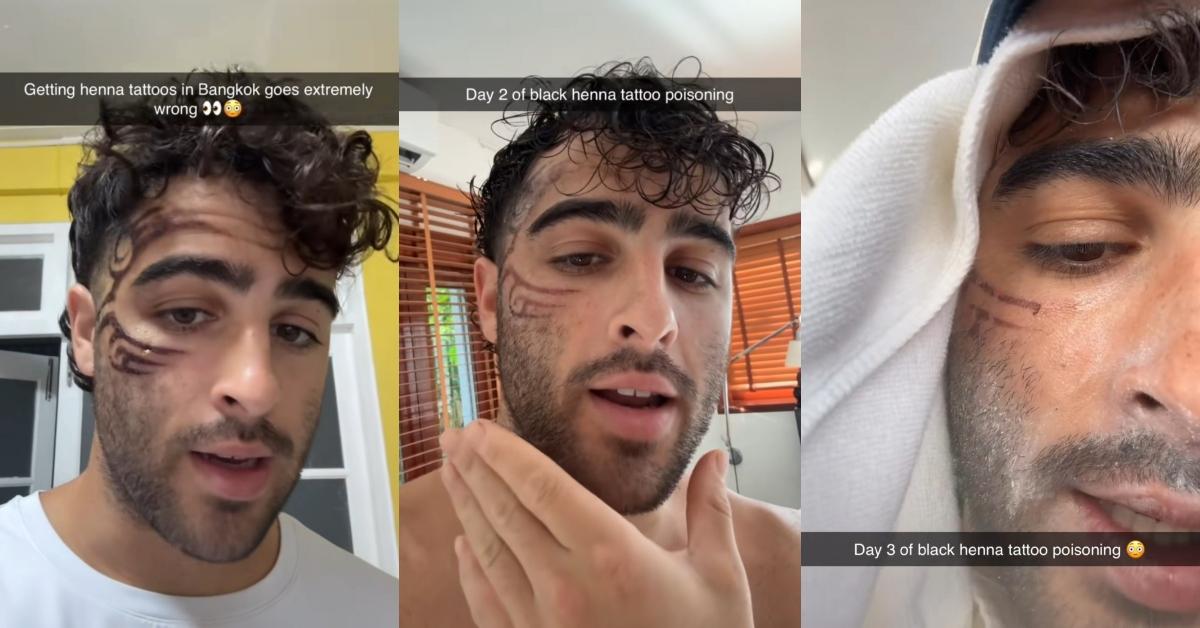 Influencer Warns Against Black Henna Tattoos — "I'm Going to Have a Full Blister Scar"