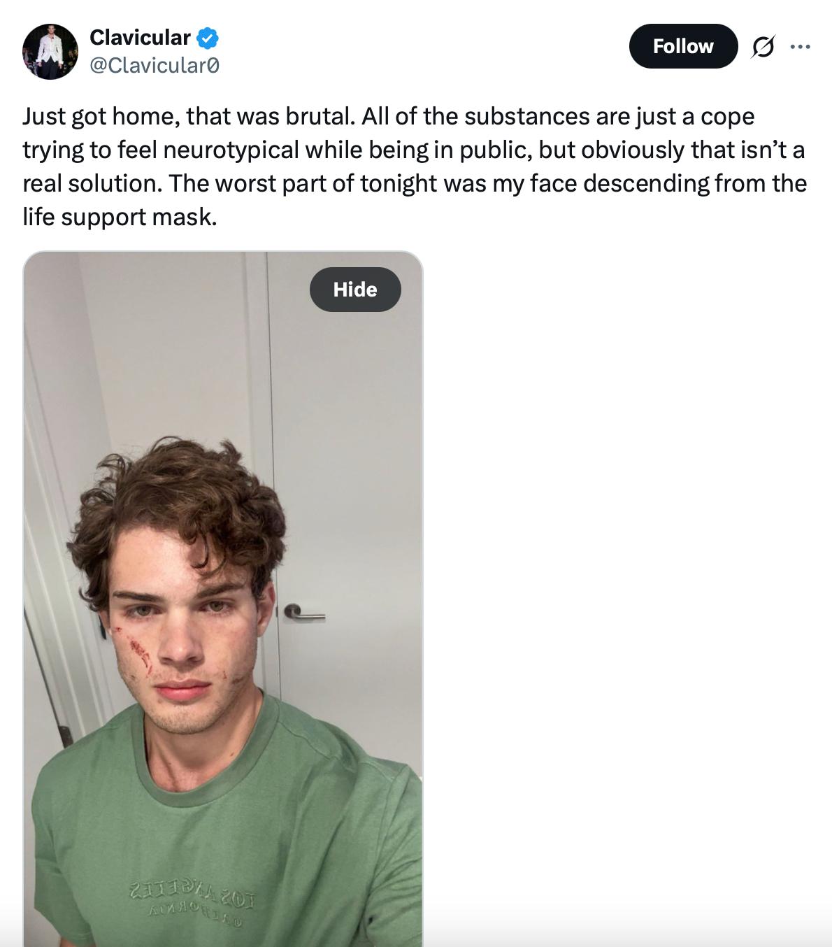 Clavicular at home after his alleged overdose.