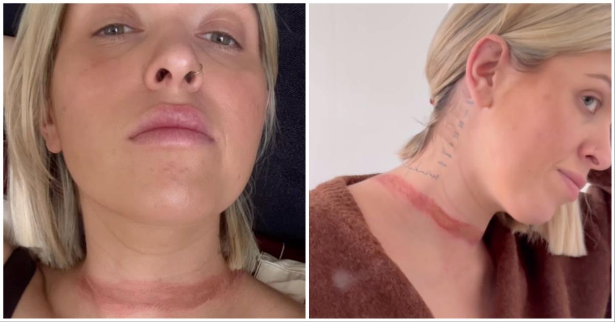 Eli Moulton shows off the scars after she is choked by her dress. 