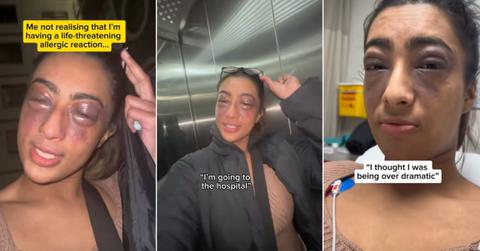 A woman has an allergic reaction to peanuts and documents the ordeal