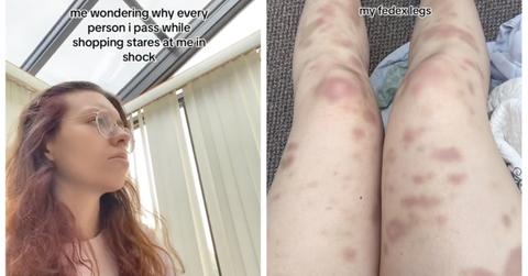 TikTok about FedEx worker's bruised legs.