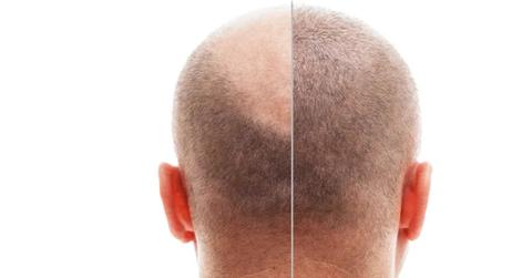 Redefining Restoration: Why Global Patients Prioritize a Hair Transplant in Turkey