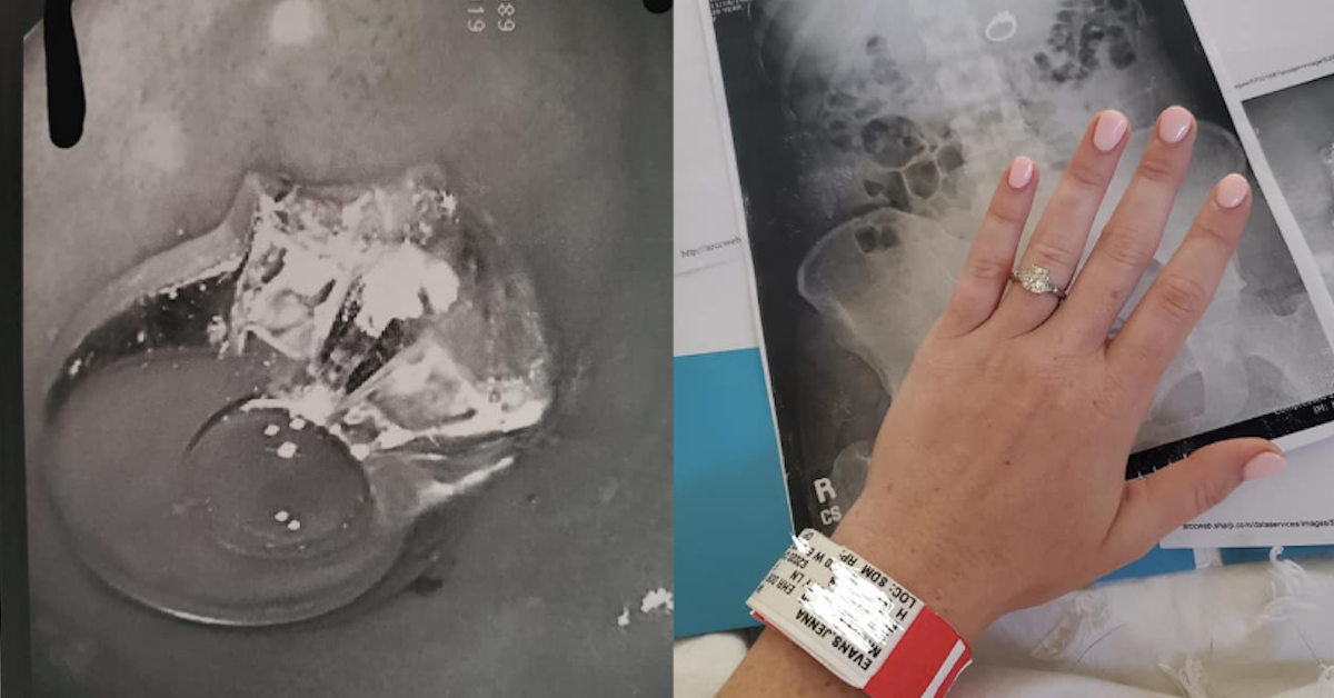 Woman Swallows Engagement Ring In Sleep While Dreaming That She Swallowed It 8737