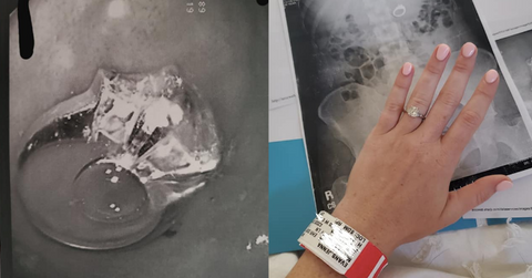 featured swallowed ring