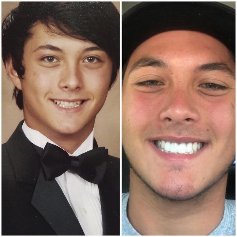 laine hardy teeth