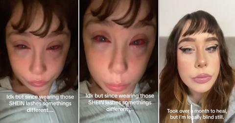 A woman explains how Shein lashes led to a severe eye infection