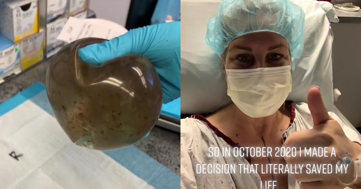 tiktoker-finds-mold-in-breast-implants-after-10-years