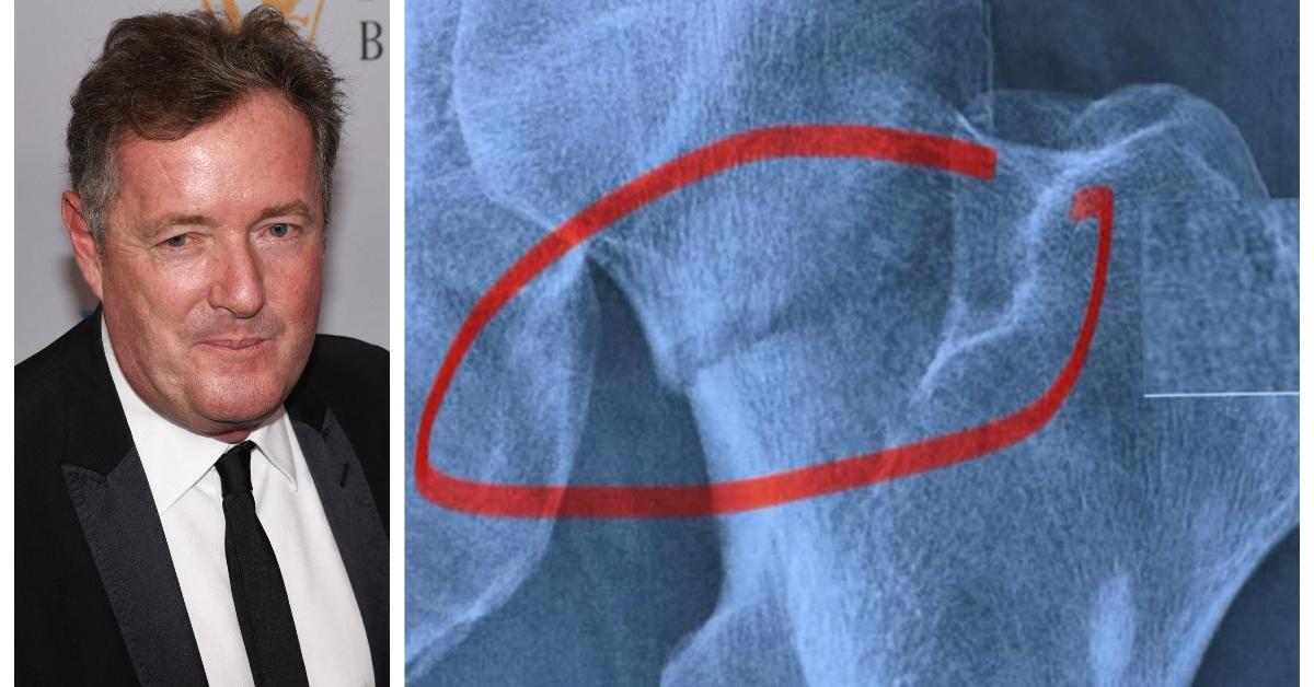 Journalist Piers Morgan Is Putting the Cast Into Broadcaster — What Happened to His Leg?