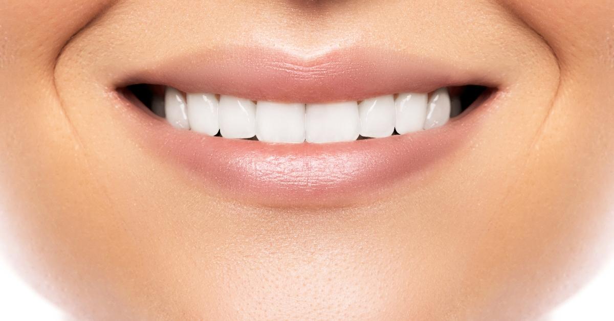 A woman smiling with veneers