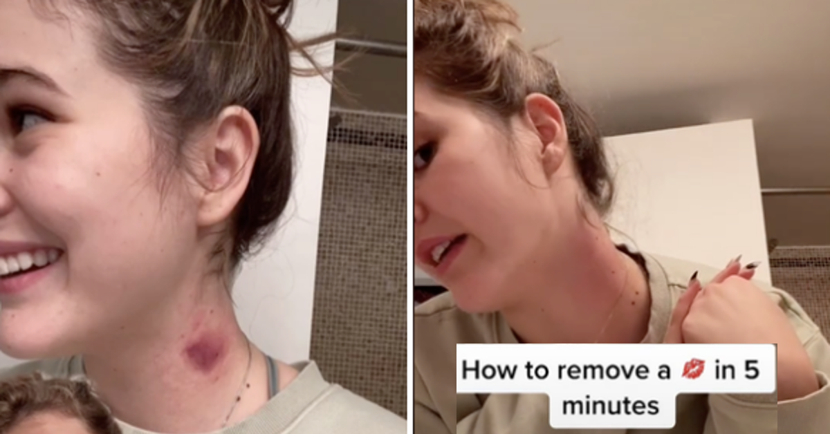 How Can You Get Rid of a Hickey Fast? - GoodRx