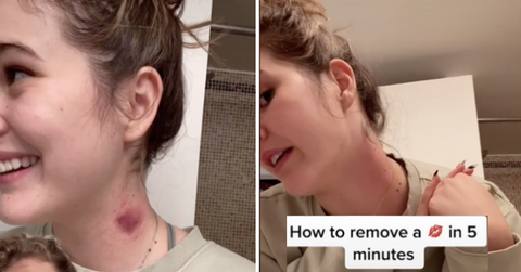 Want to Know How to Get Rid Of a Hickey? Let TikTok Be Your Muse