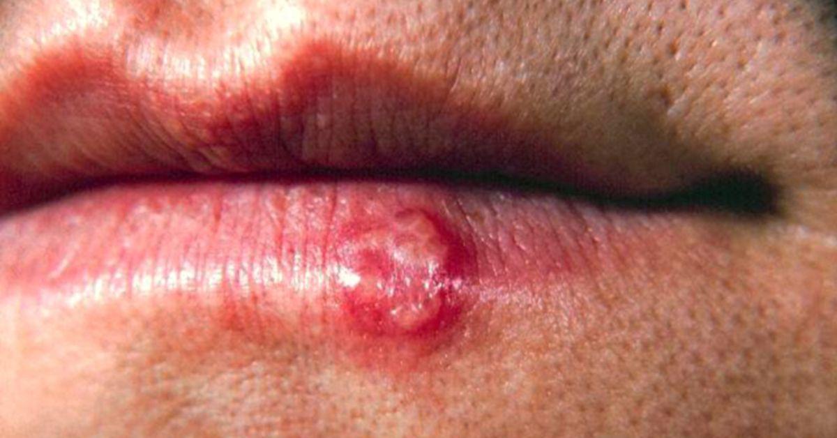 A close-up of the lip of a patient with a herpes simplex lesion on the lower lip due to the (HSV1) pathogen