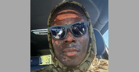 David Njoku with burns on his face in the car.