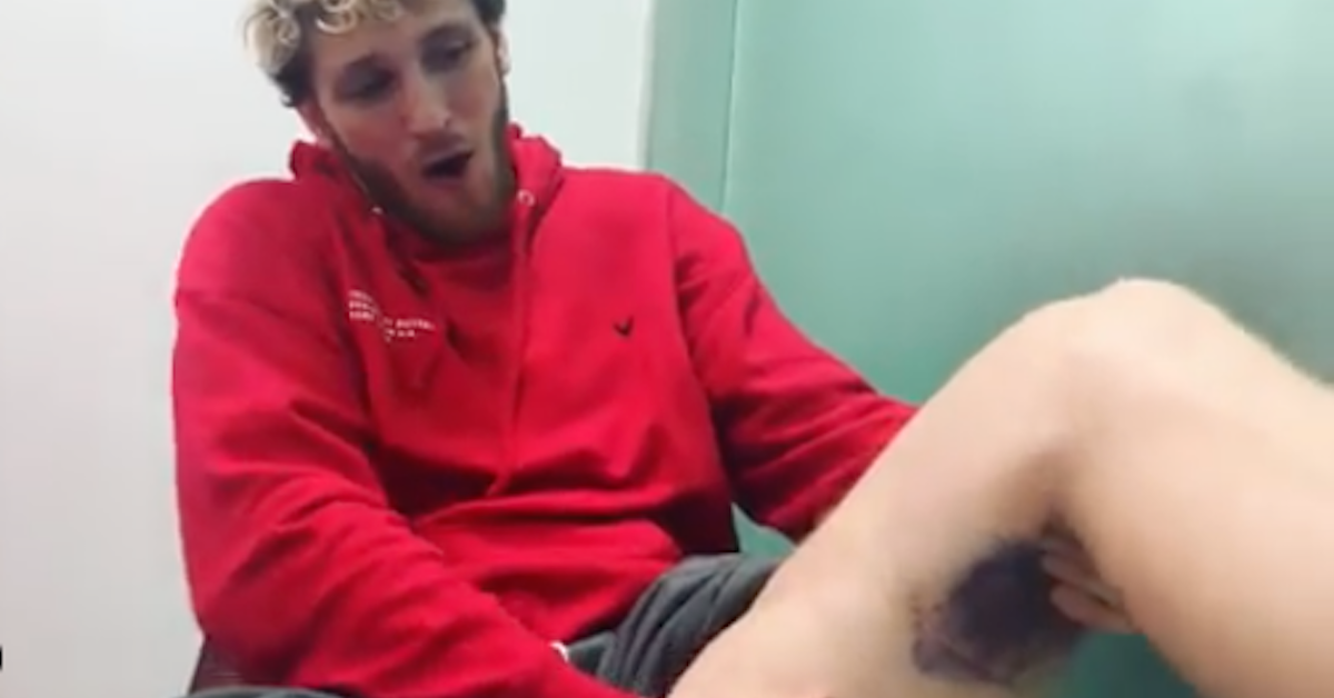 what happened to logan pauls leg