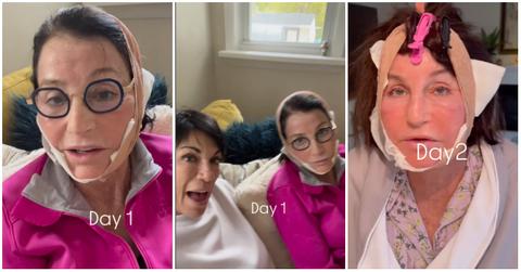 kathy after her face lift