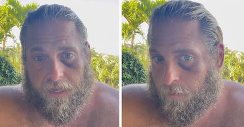 Jonah Hill Black Eye