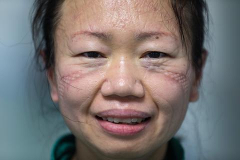 Healthcare Workers are Sharing Photos of Their Bruised Faces to ...