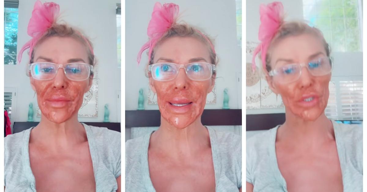 What Happened to Brandi Glanville's Face? What to Know