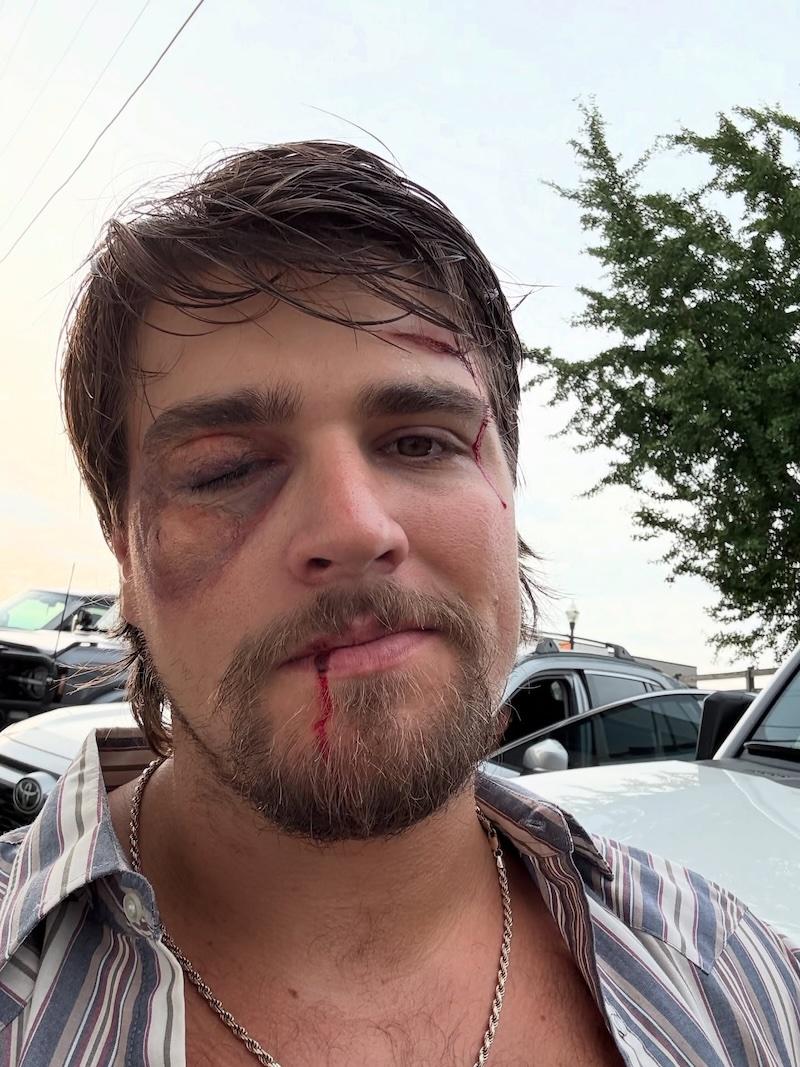 gavin adcock bruise face