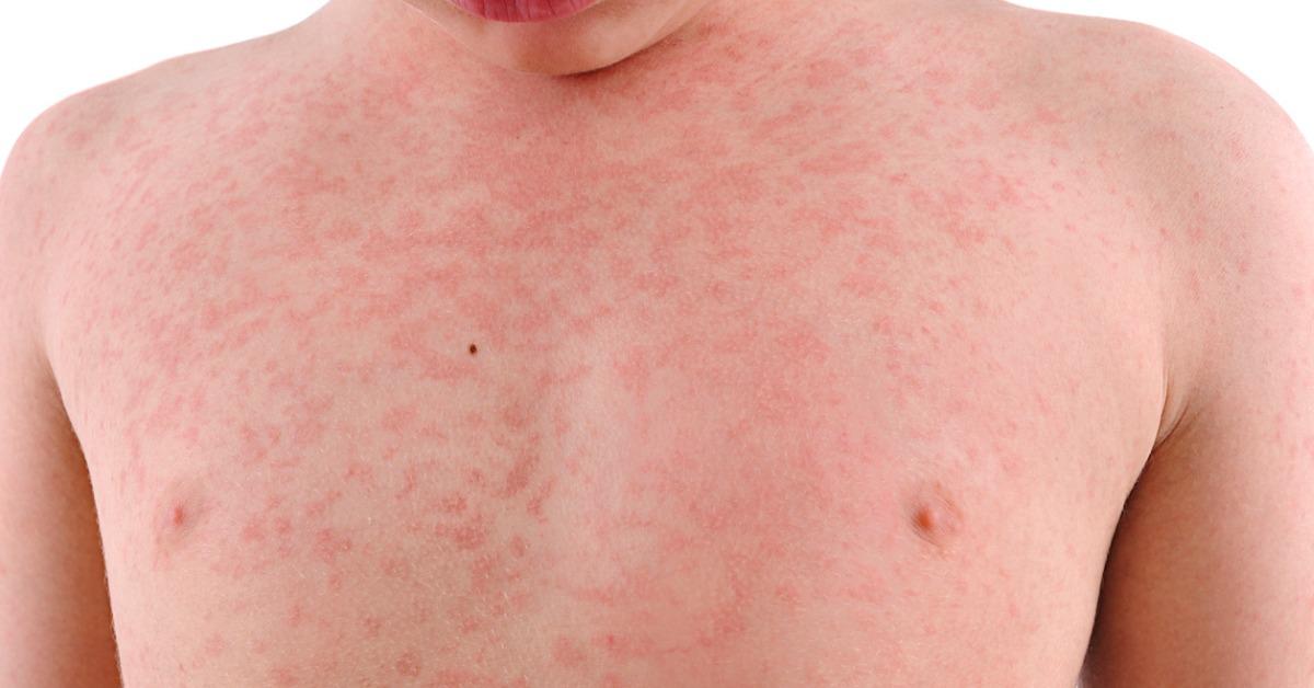 nettle-rash-isolated-picture-id615100740-1535572510948-1535572512601.jpg