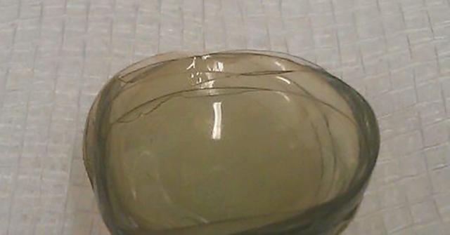 Doctors Discover 27 Contact Lenses Stuck In Patient's Eye