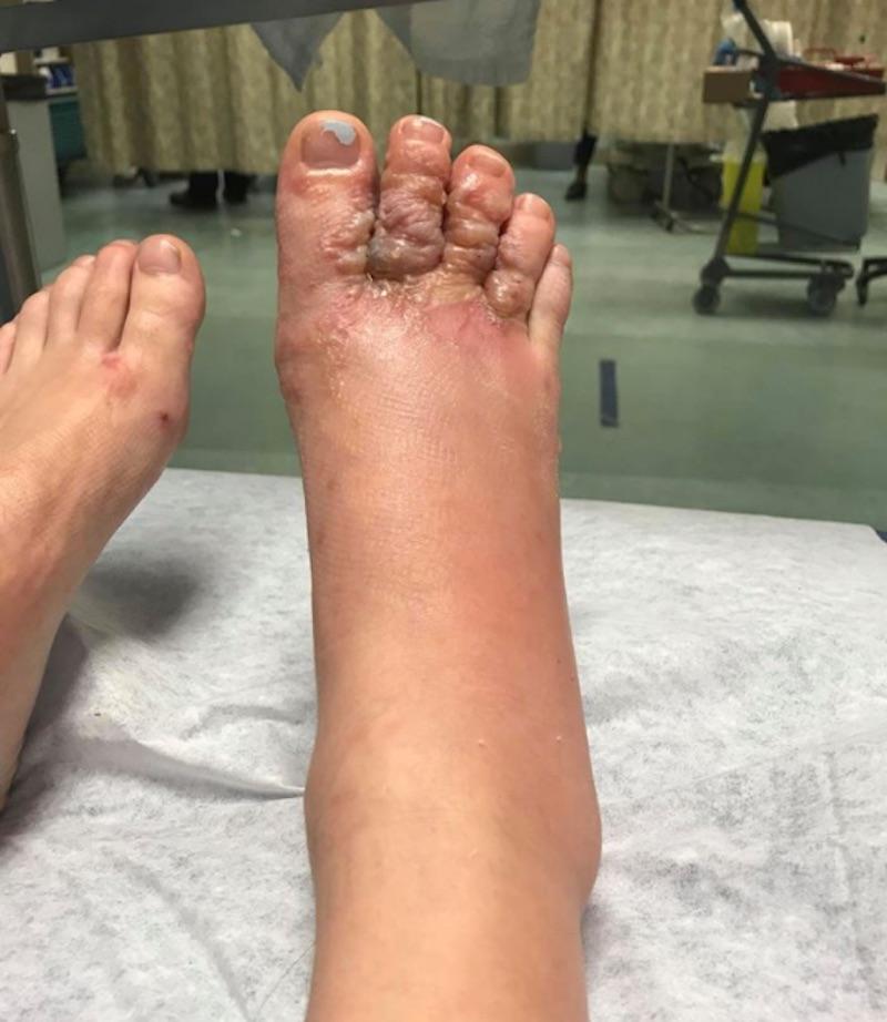 Warning about walking barefoot after teen contracts hookworms at Florida  beach