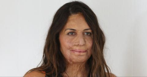 What Happened to Turia Pitt? All About the Australian Author