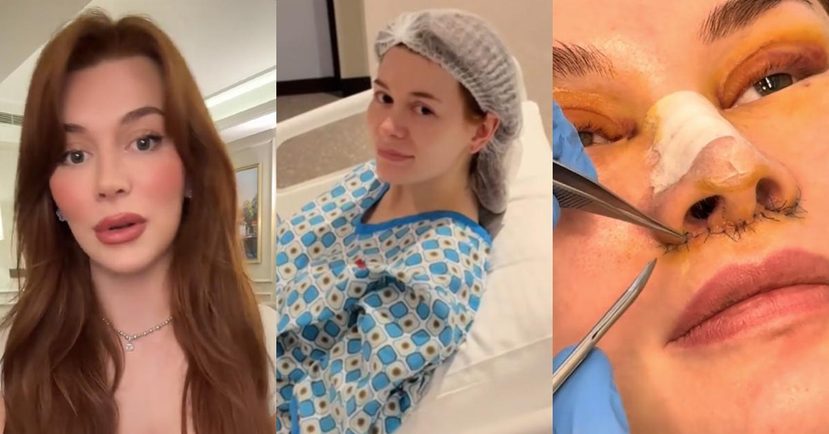 28-Year-Old Influencer Gets Face Lift 