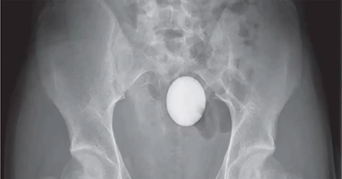 x-ray of a pelvis with a golf ball in it