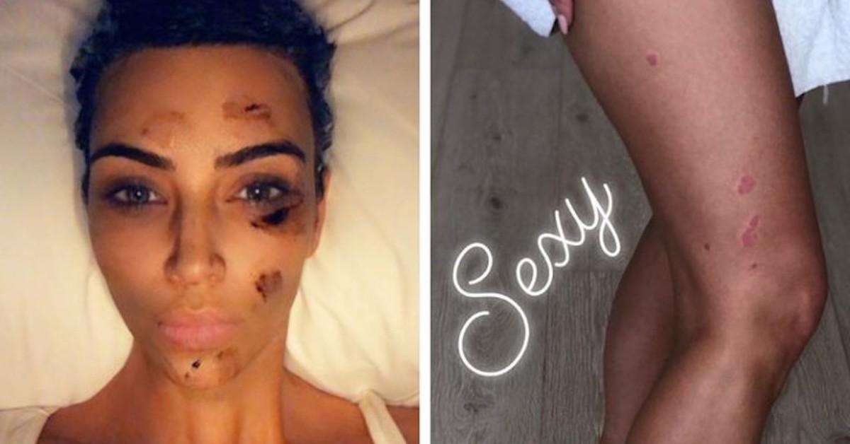 Kim Kardashian on Instagram in 2019 sharing photos of her psoriasis