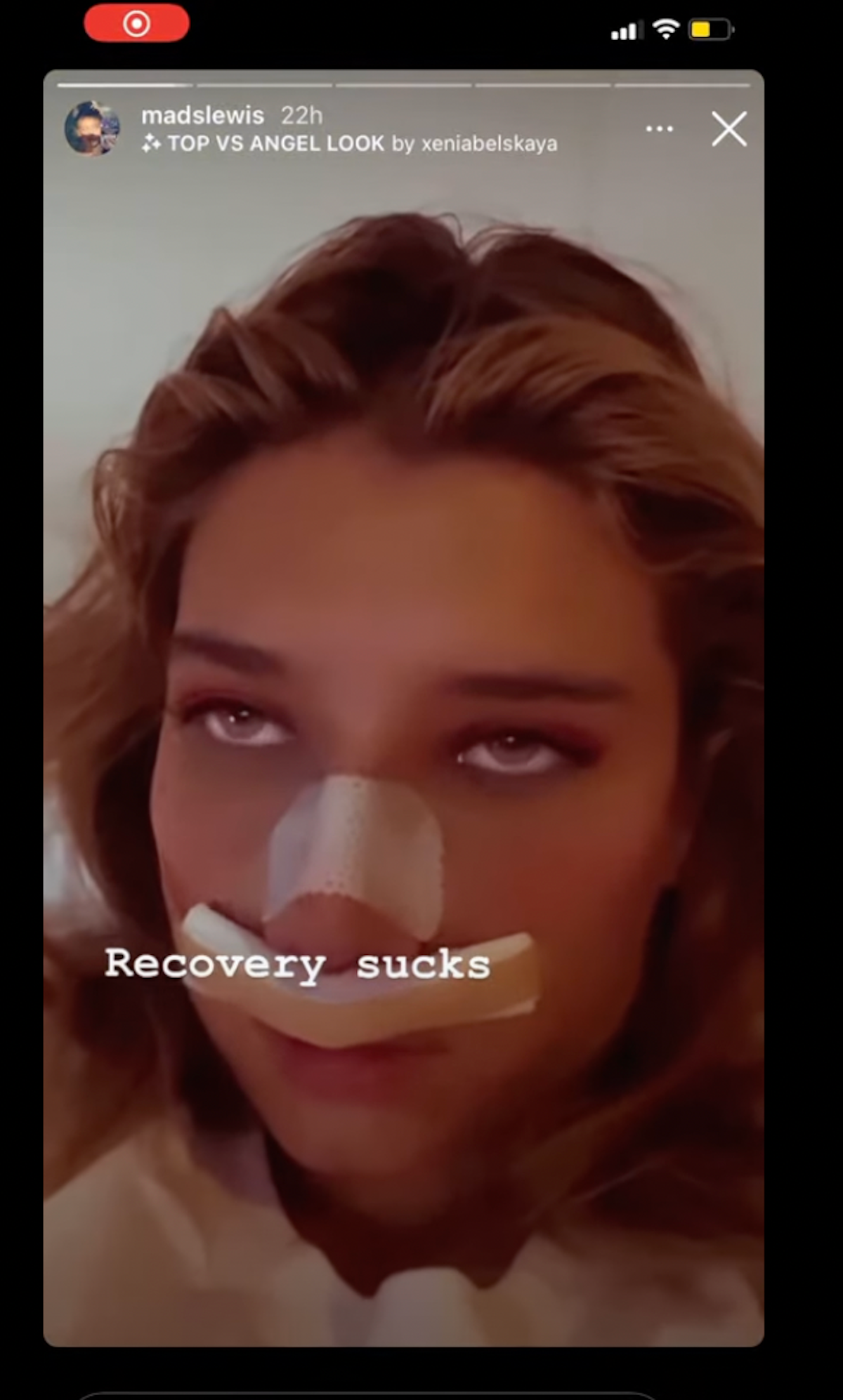 mads lewis nose job recovery