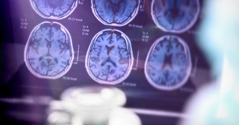 alzheimers-featured-1560272885226.jpg