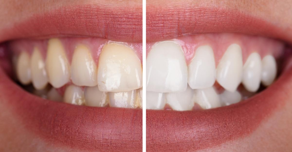 hydrogen peroxide teeth before and after