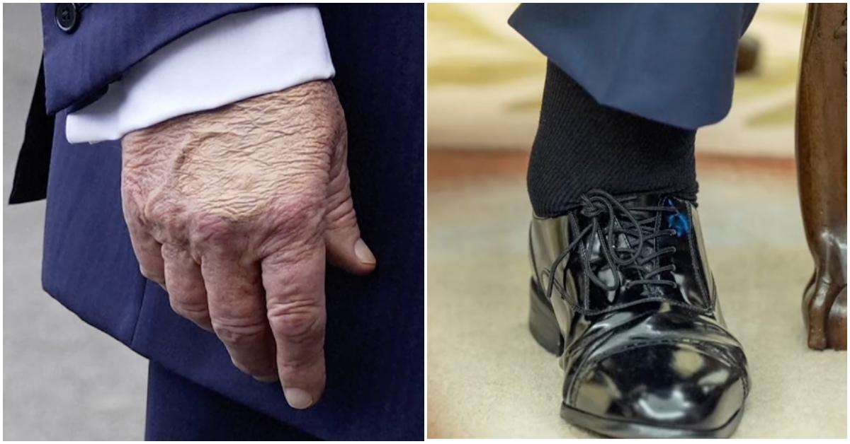 Donald Trump's swollen hand and foot.
