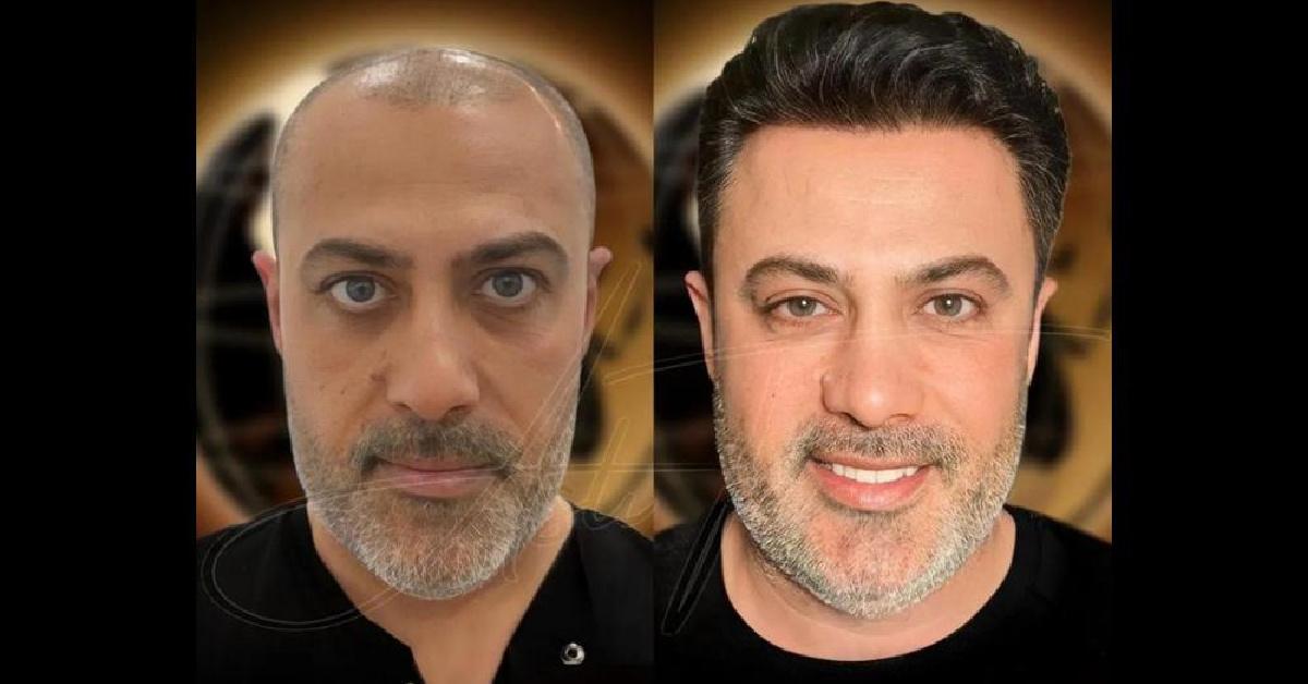 Top 10 Best Hair Transplant in Turkey: Clinics You Can Trust