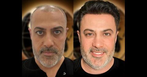 Top 10 Best Hair Transplant in Turkey: Clinics You Can Trust
