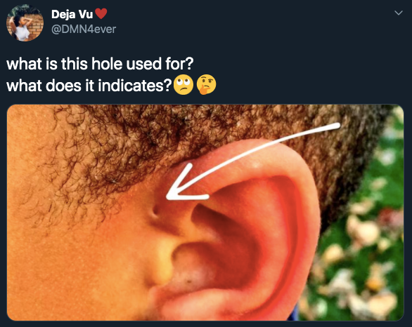 Some people are born with tiny holes above their ears – this is
